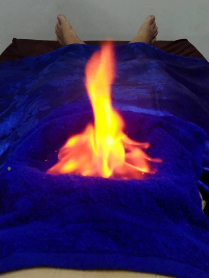 Flame above a herbal preparation surrounded by a blue towel during a traditional heat procedure